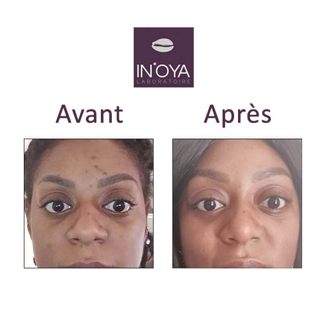 Avant/après routine anti taches brunes inflammatoires sur la zone T du